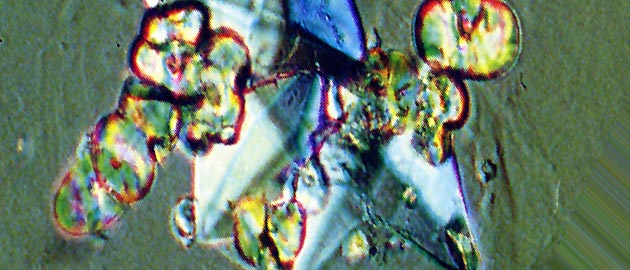 Calciumoxalatkristalle im Urin, 
Foto von Prof. Dr. med. R. Schindler, Charit